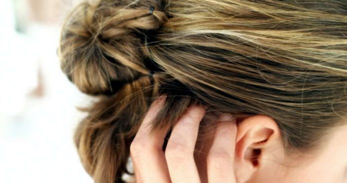 Forfora: cause rimedi naturali cosa fare e come eliminare la forfora Forfora: cause rimedi naturali cosa fare e come eliminare la forfora