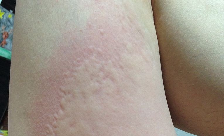 Orticaria - foto ,cause, sintomi, rimedi naturali