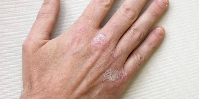 Psoriasi - cause sintomi rimedi naturali alimentazione