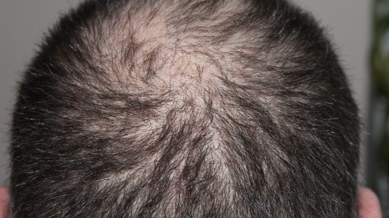 Calvizie E Alopecia Come Rimediare Agli Inestetismi Provocati Dalla Caduta Dei Capelli