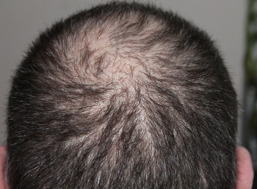 Alopecia