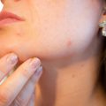 Acne ormonale: cos'è, le cause e quali sono i rimedi