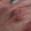 Pelle secca e irritata: cause e rimedi