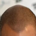 La tricopigmentazione come metodo per nascondere la perdita dei capelli